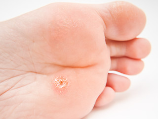 Image showing Callus under foot