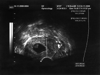 Image showing ultrasound fetus portrait