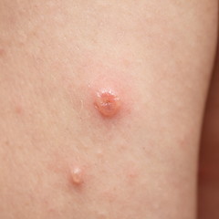 Image showing chicken pox blotch