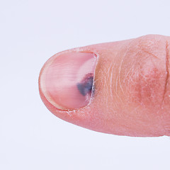 Image showing Subungual hematoma under nail