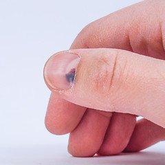 Image showing Subungual hematoma under nail