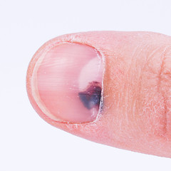 Image showing Subungual hematoma under nail