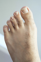 Image showing Cracked Fungus Toenails