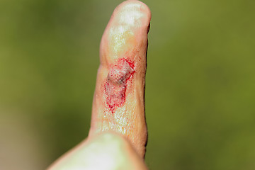 Image showing wound on male finger