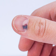 Image showing Subungual hematoma under nail