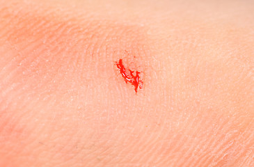 Image showing Bleeding thumb finger