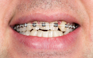 Image showing smile with braces on teeth