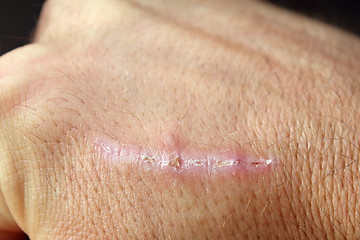 Image showing scar on man hand