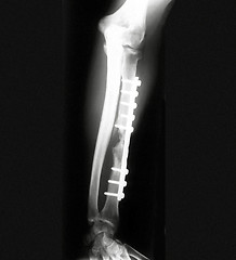 Image showing X-ray of Forearm