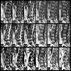 Image showing x ray of spine