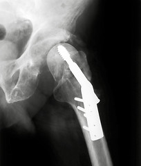 Image showing X-rayed Hip