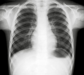 Image showing X-ray of lungs