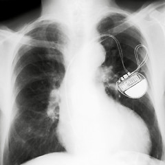 Image showing X-rayed chest