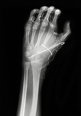 Image showing X ray image of hand