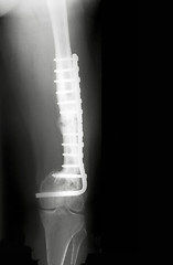 Image showing X-Rayed Thigh