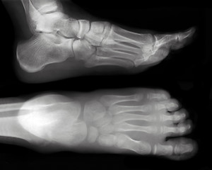 Image showing Foot-X-Ray