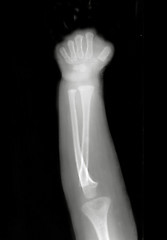 Image showing Forearm