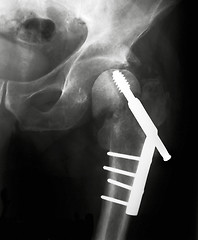 Image showing X-rayed Hip