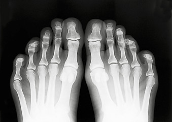 Image showing Foot fingers