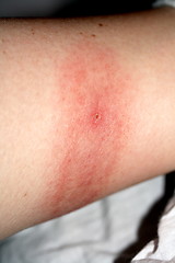 Image showing Borelia infection