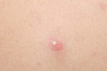 Image showing pimple