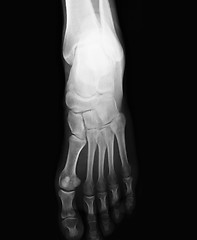 Image showing foot  xray