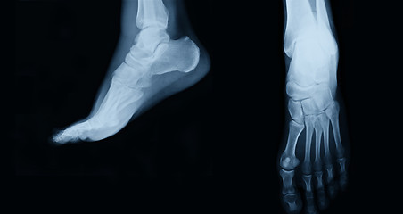 Image showing foot  xray