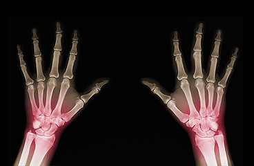 Image showing X-ray of hands