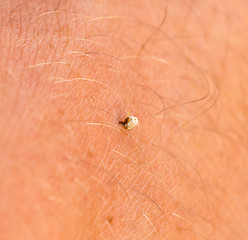 Image showing Bee Sting Stuck In Human Skin