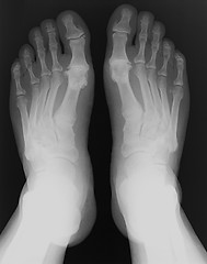 Image showing X-ray foot
