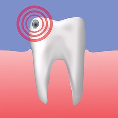 Image showing hole in the tooth