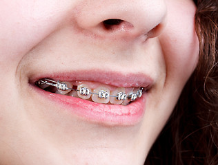 Image showing Woman with brackets 