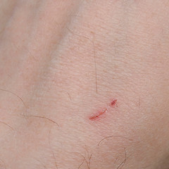 Image showing Hand scar