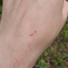 Image showing Hand scar