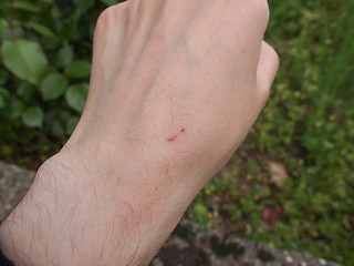 Image showing Hand scar