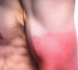 Image showing Sunburn male biceps