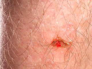 Image showing Wound with blood