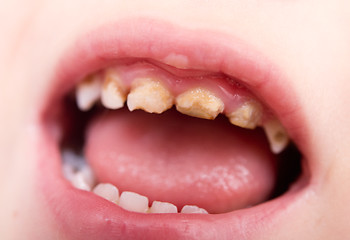 Image showing bad teeth