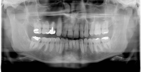 Image showing rtg (x-ray)  photo of man teeth 