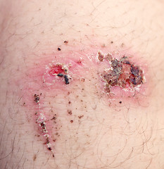 Image showing wound