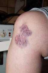 Image showing Bruising