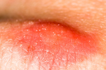 Image showing Mosquito bite