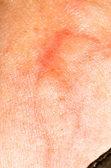 Image showing Mosquito bite