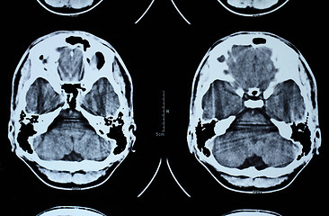 Image showing CT and MRI of the skull