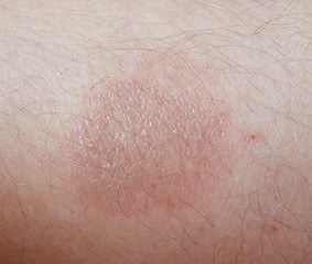 Image showing burn on skin