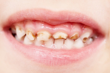 Image showing bad teeth