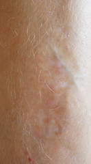 Image showing scar on skin