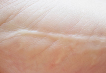 Image showing scar on skin