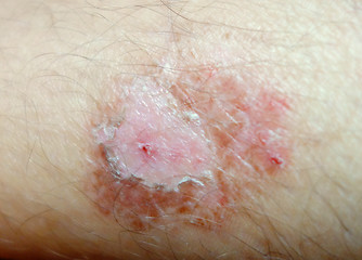 Image showing burning skin