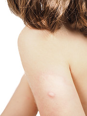 Image showing Child with hive, rash, or some skin abnormality towards white